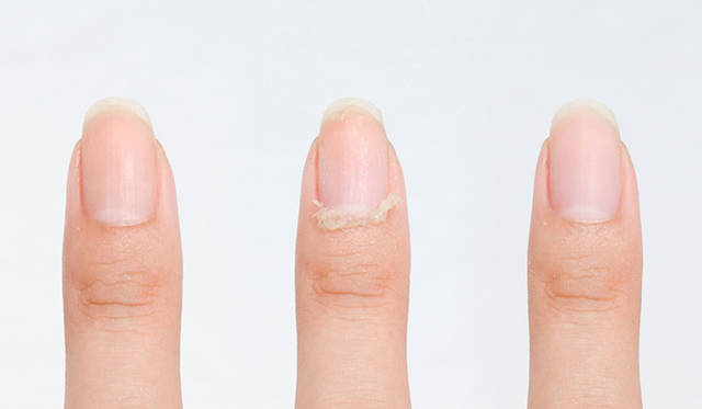 <strong> KOBAKO｜KOBAKO nails </strong>　左から、ケア前、甘皮を押し上げたケア中、ルースキューティクルと甘皮をオフしたあと。
